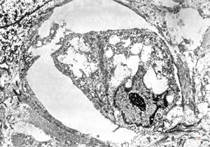 F,38y. | ovary - adenocarcinoma